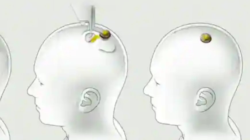 Elon Musk's Neuralink receives government approval to implant microchips in human brains and releases a video.